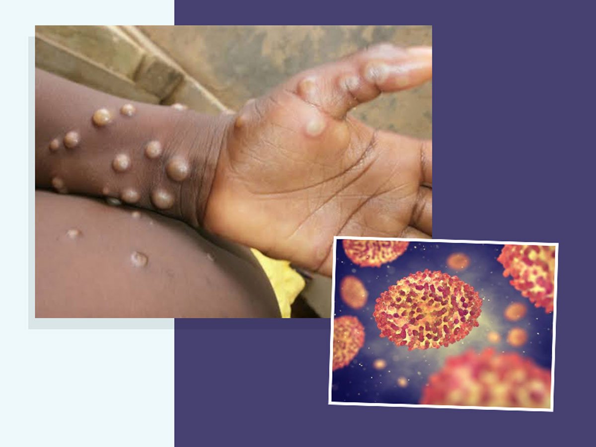 large-6monkeypox