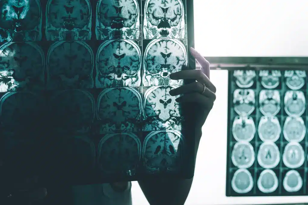 ALZHEIMER